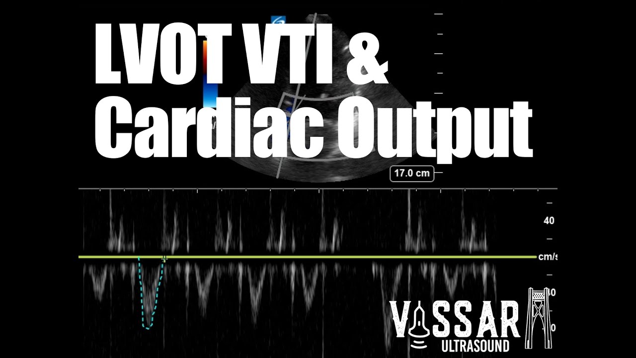 LVOT VTI