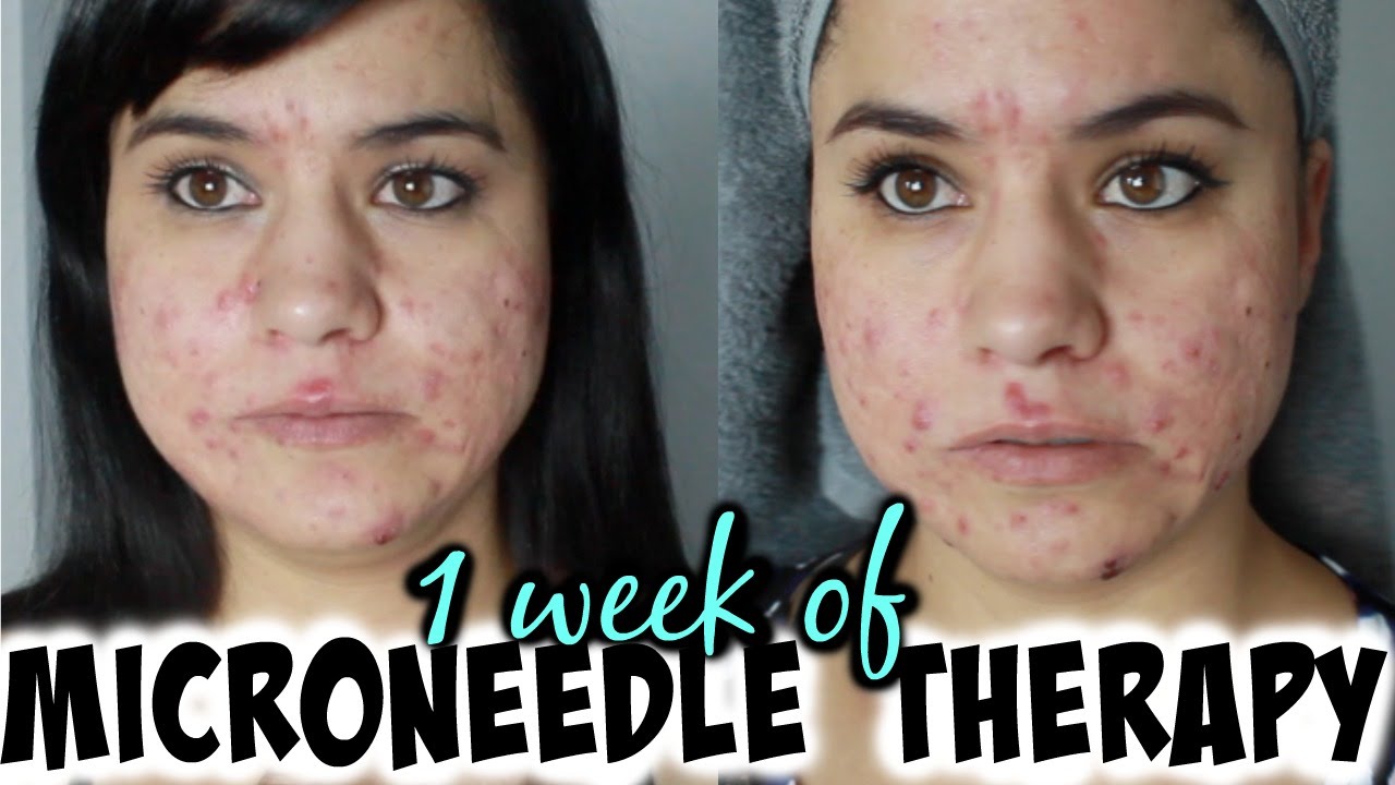 1 wk using derma roller - Mamiposa26