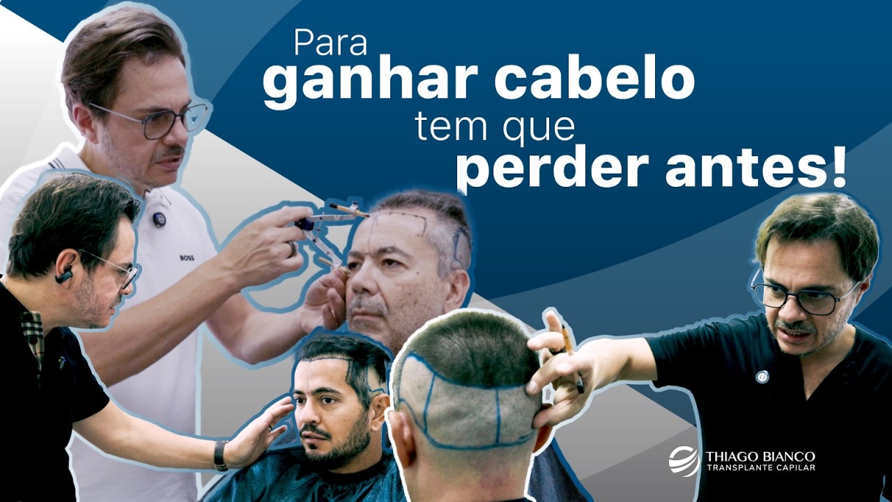 FUE Ultradensidade ® - Casos da Semana | Dr. Thiago Bianco