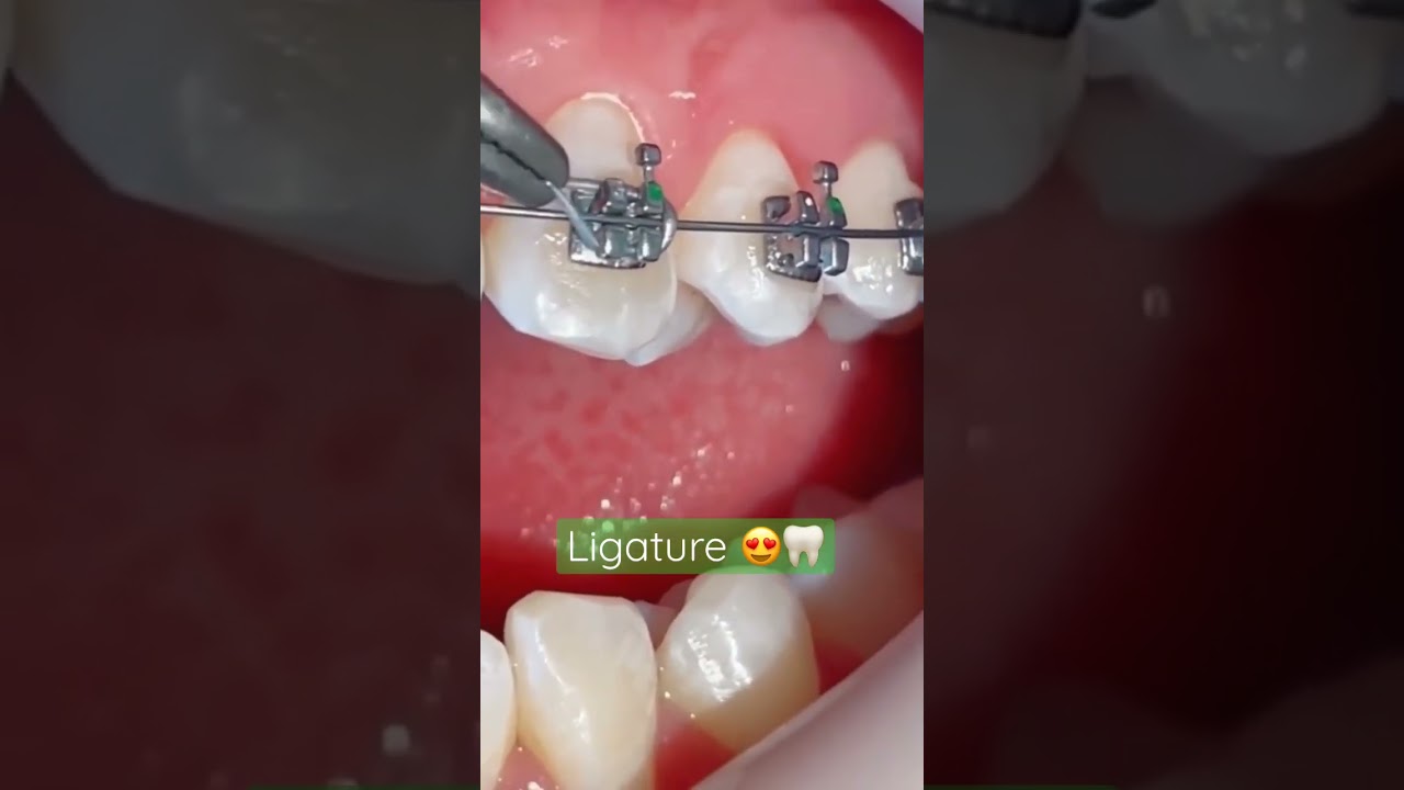 How Ligature Placed on the Bracket|Ligature Placed on Braces|Orthodontic Dentistry Treatments🦷
