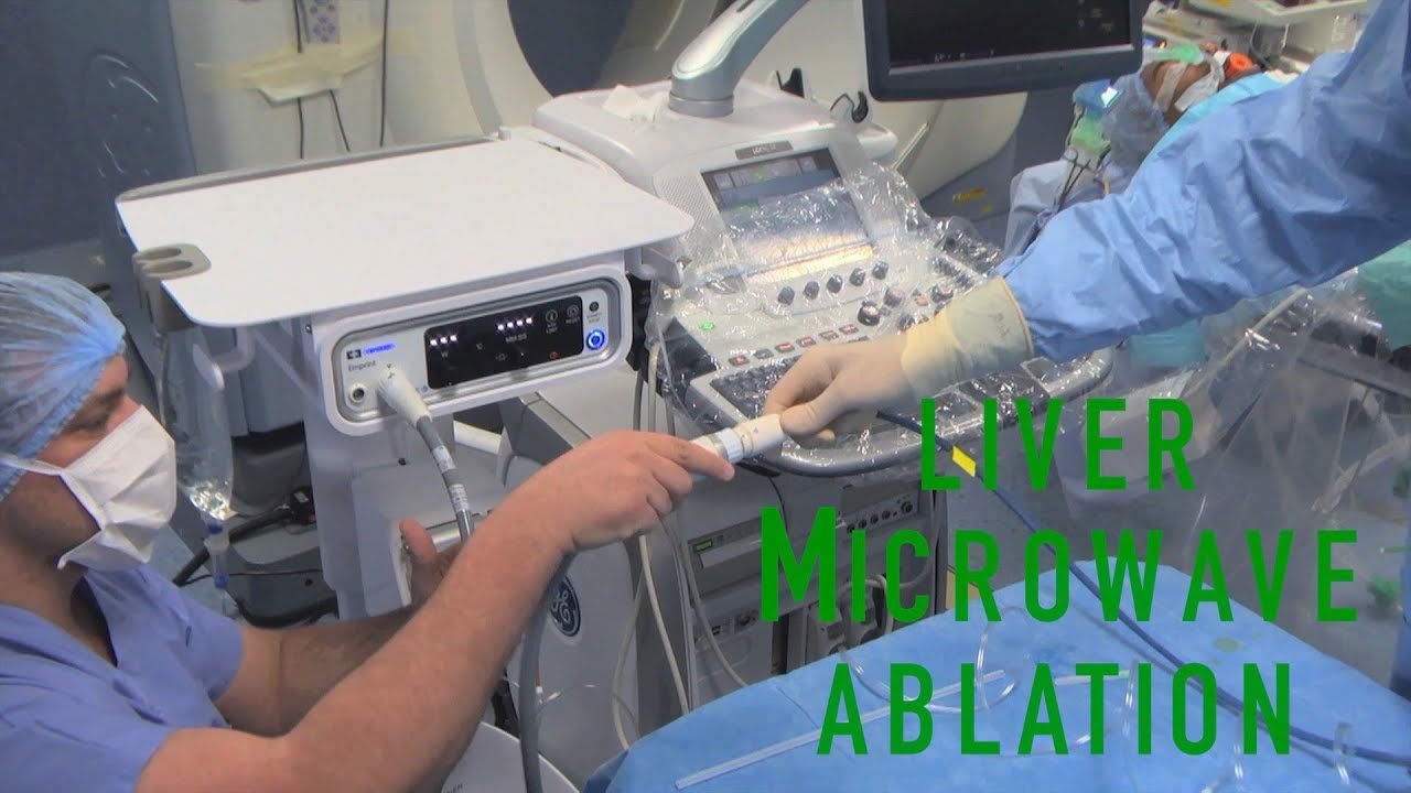 Microwave ablation of a single lesion of liver