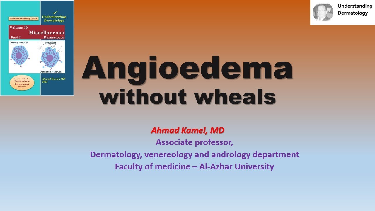 04 Angioedema without wheals