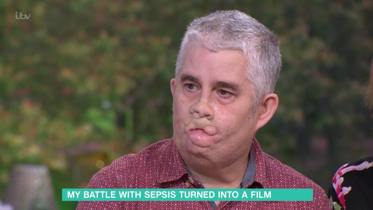 Life After Sepsis Caused Amputations | This Morning