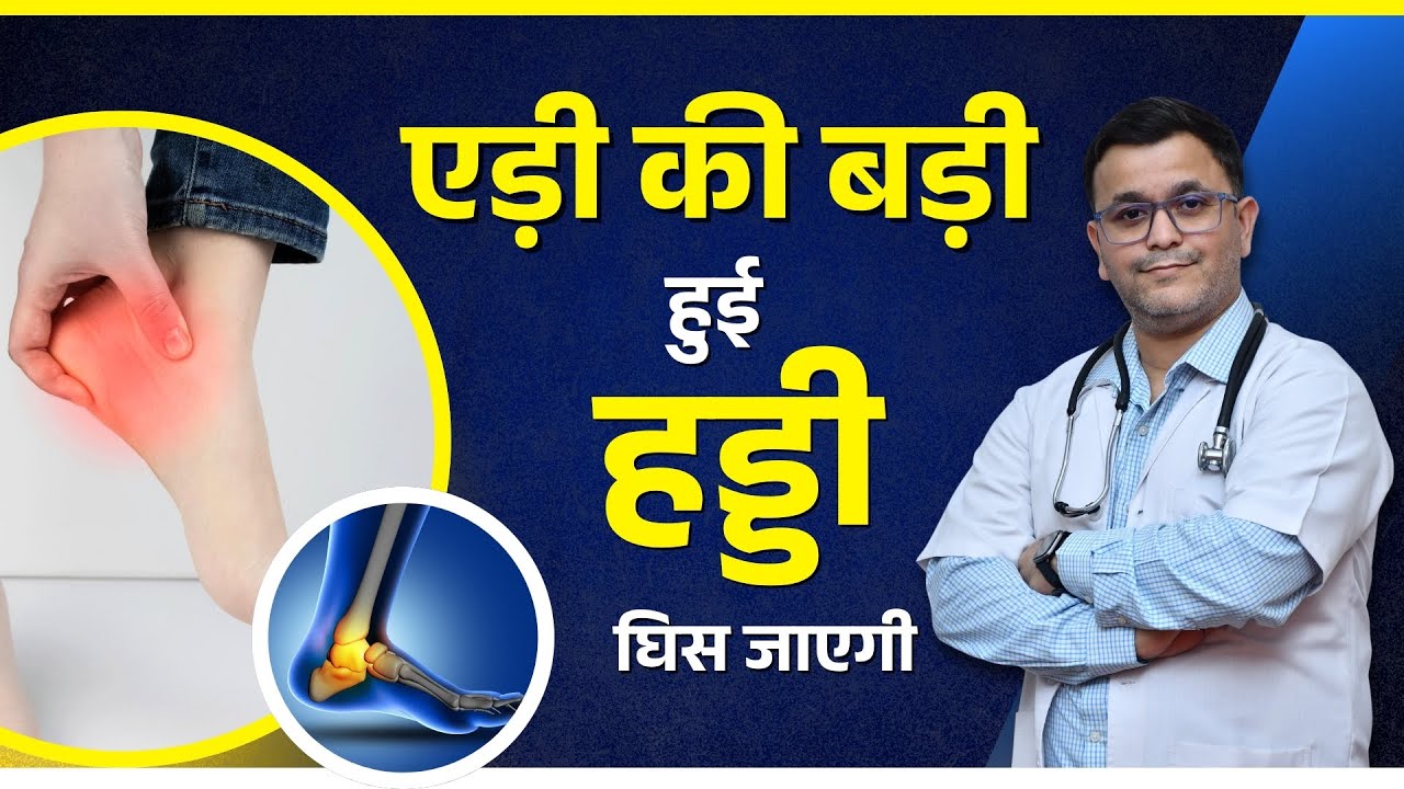 एड़ी की हड्डी बढ़ जाए तो क्या करें? 3 BEST Homeopathic medicine for HEEL spur