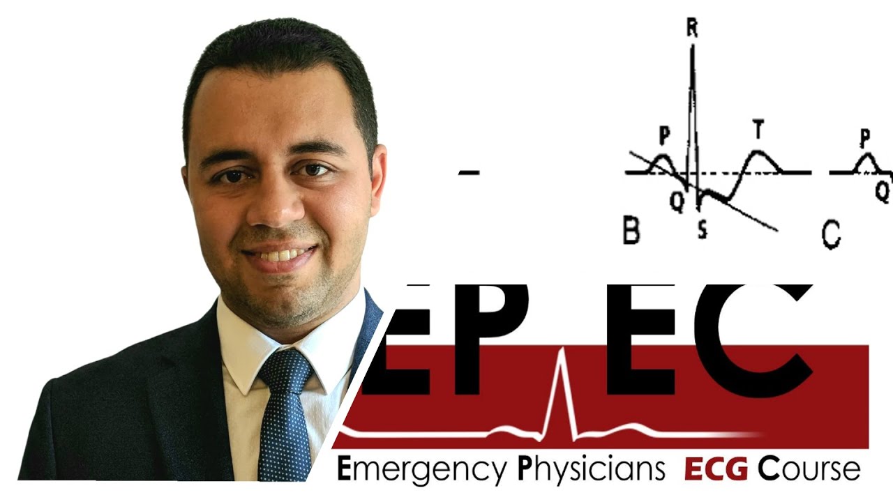 ECG Tip 3. The ST segment is depressed, Is that BAD?
