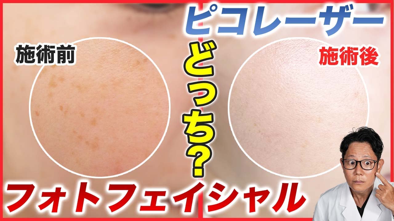 ピコレーザーとフォトフェイシャルの効果の違いを解説【シミ/肝斑】