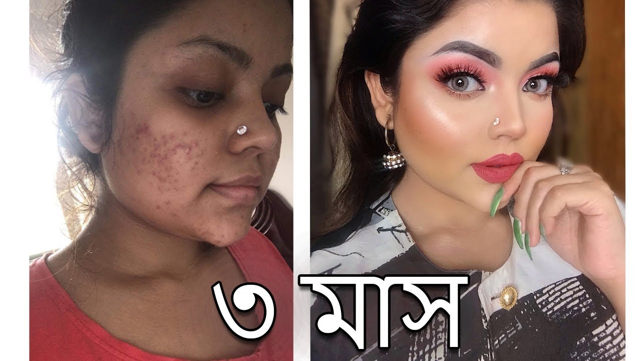 যেভাবে পিম্পল কমালাম । WINTER SKIN CARE ROUTINE 2020
