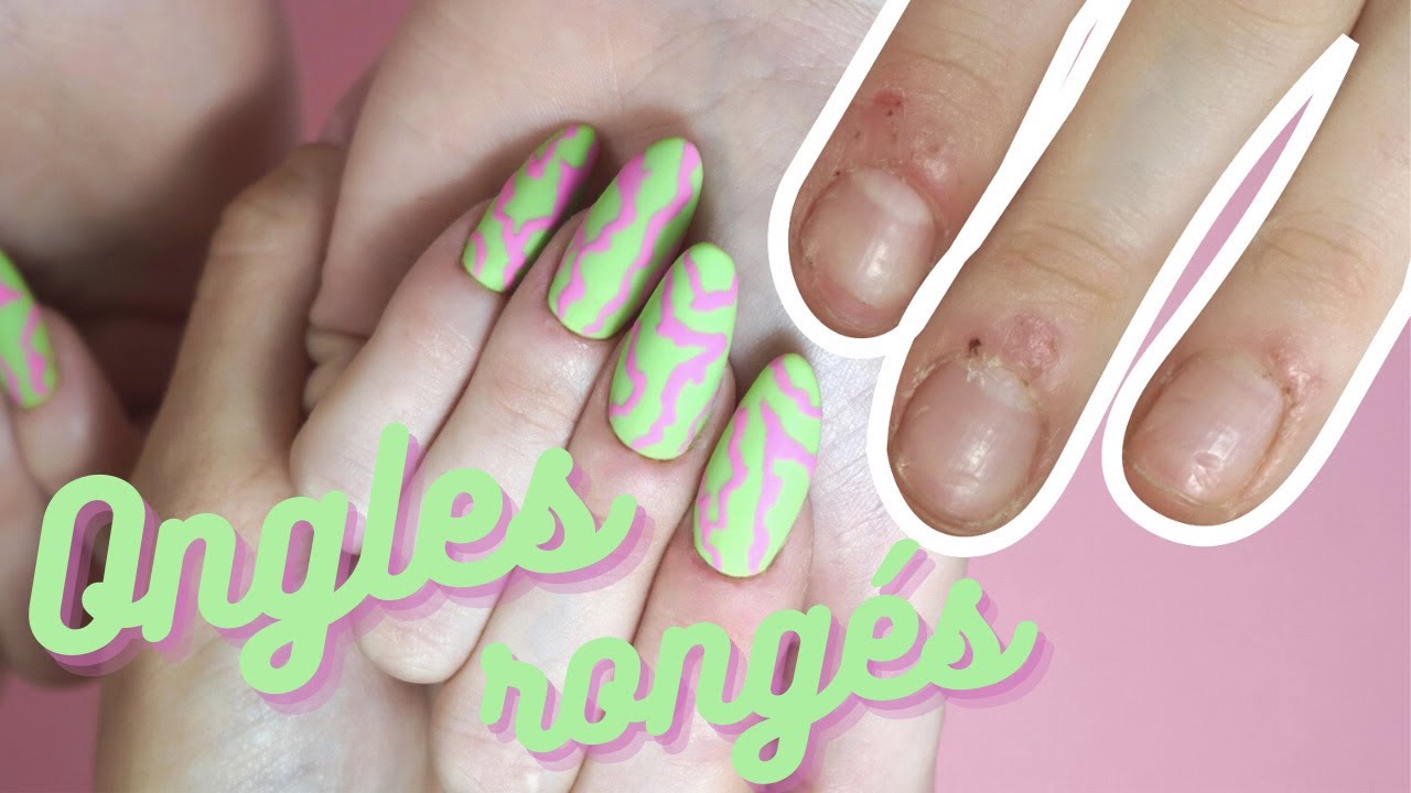 Tutoriel EXTENSION CHABLON 💅🏻 sur ONGLES RONGÉS avec des bobos 🩹 partout
