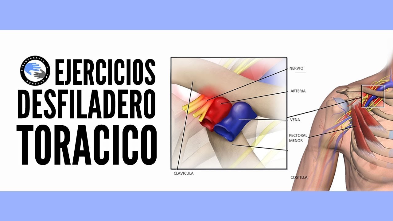 Sindrome del desfiladero toracico, ejercicios para aliviar los sintomas