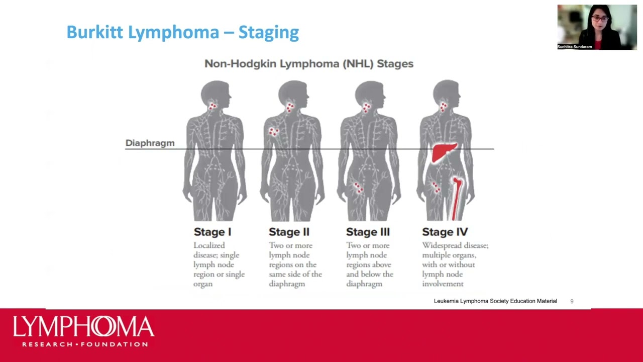 Burkitt Lymphoma