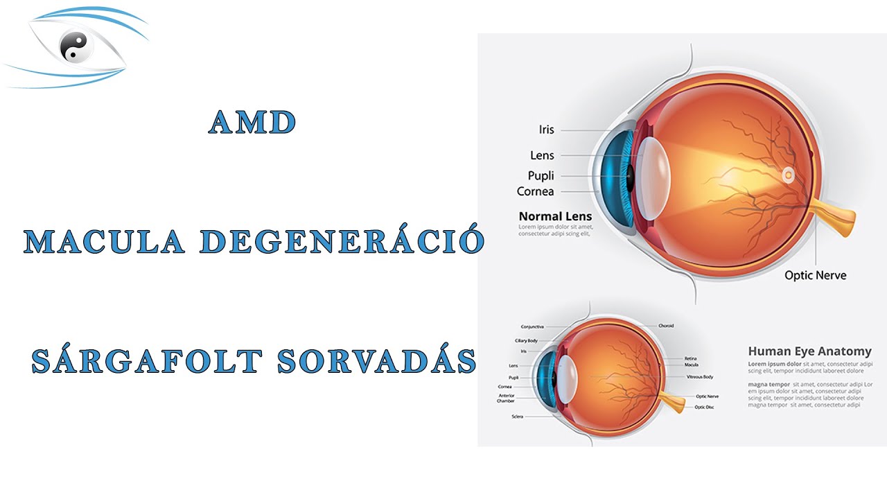AMD - Macula degeneráció - Sárgafolt sorvadás