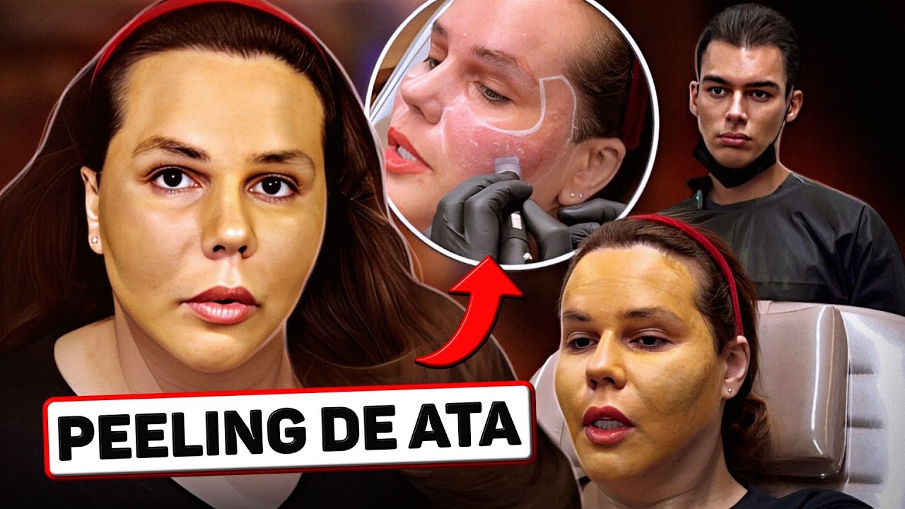 FIZ PEELING DE ATA 💉 Adeus RUGAS e CICATRIZES DE ACNE?
