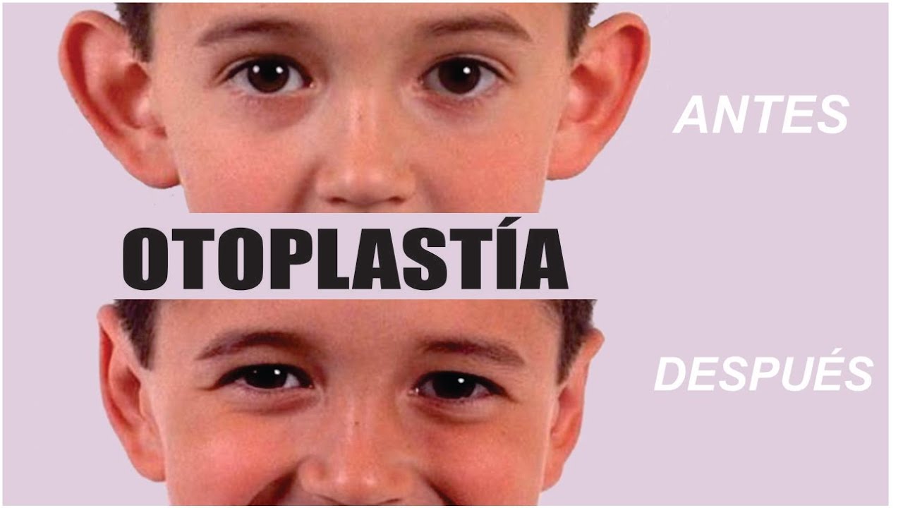 &iquest;QU&Eacute; es la OTOPLAST&Iacute;A? 👂 TIPOS de CIRUG&Iacute;A de OREJAS ⭐ Dr. ALBERTO CALVO QUIROZ