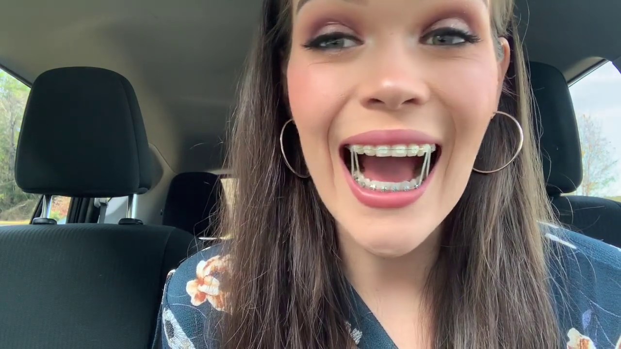 JAW SURGERY EXPERIENCE: 3 MONTH UPDATE | Pain, Swelling & My New Bite!
