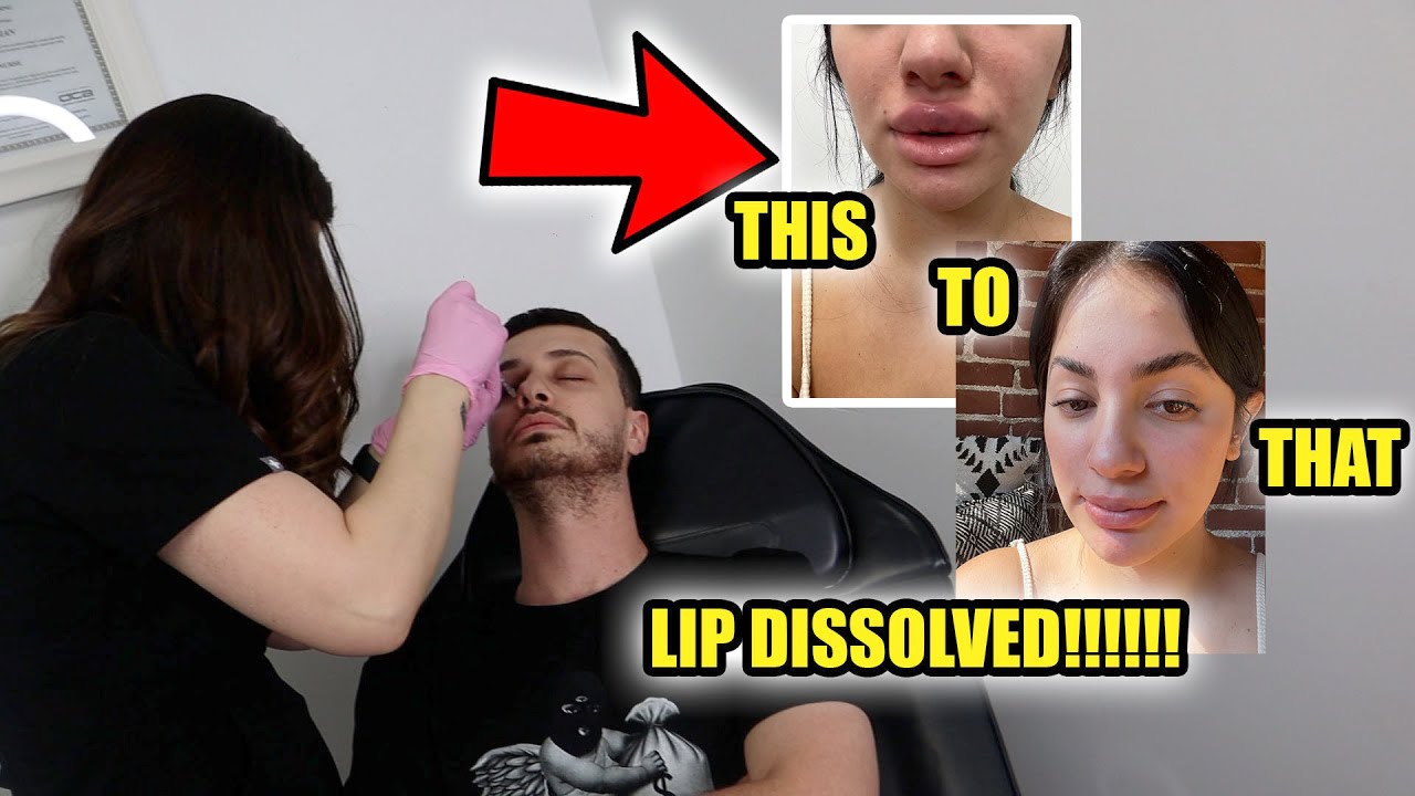 I GOT MY LIPS DISSOLVED HERES WHY.. FERN GOT FILLER!!! OMG😮