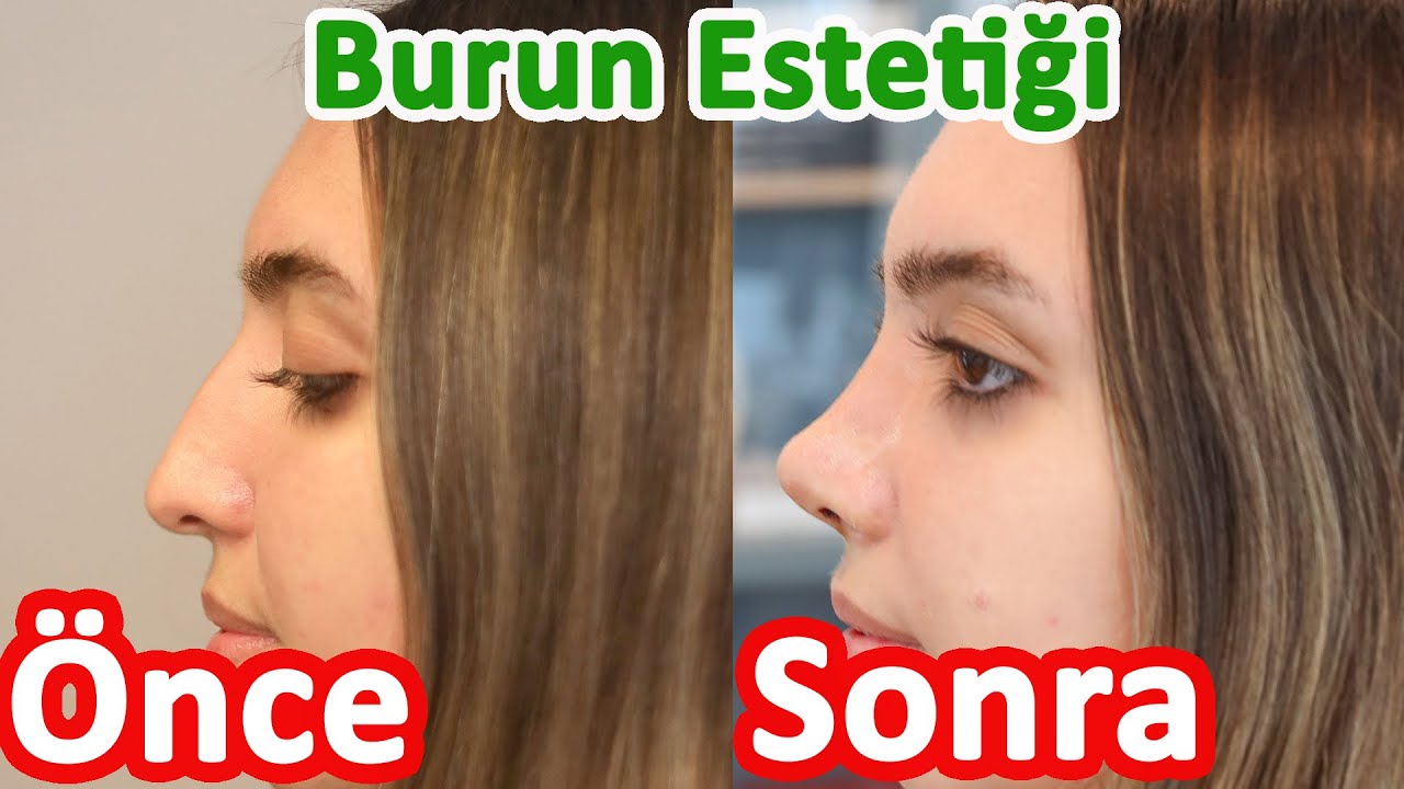 İzsiz Burun Estetiği Ameliyatı Sürecimiz - Eylül 2021- Op.Dr.Behçet Şahin  #burunestetiği