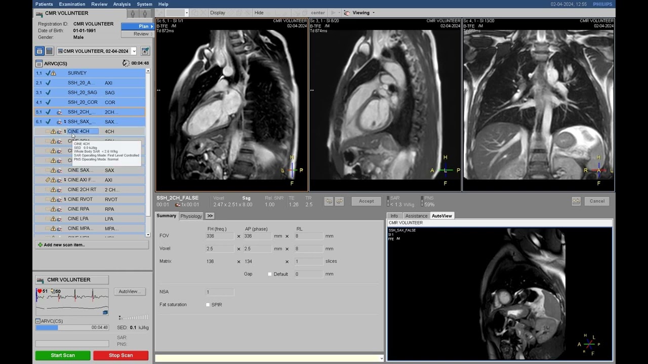 Cardiac MR CMR Philips Achieva1.5 dStream Upgraded System