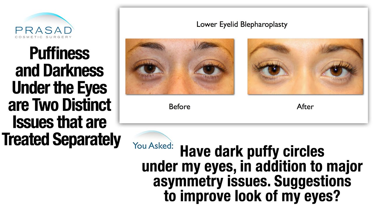 How to Choose Between Cosmetic Fillers or Surgery to Treat Puffy Eye Bags and Dark Circles