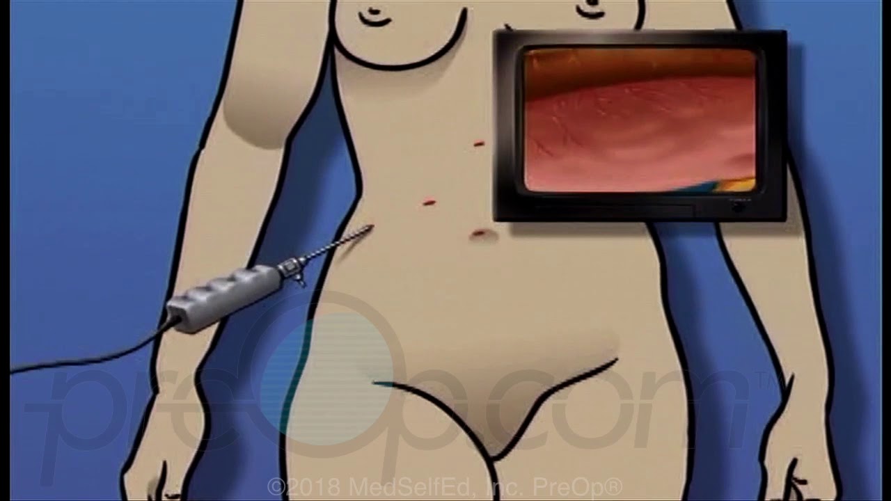 Anti Reflux Laparoscopy Surgery • PreOp Patient Education • Patient Engagement
