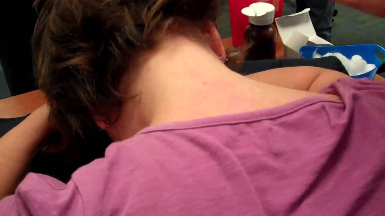 McMaster Medical Acupuncture Program: Acupuncture Point GB 20