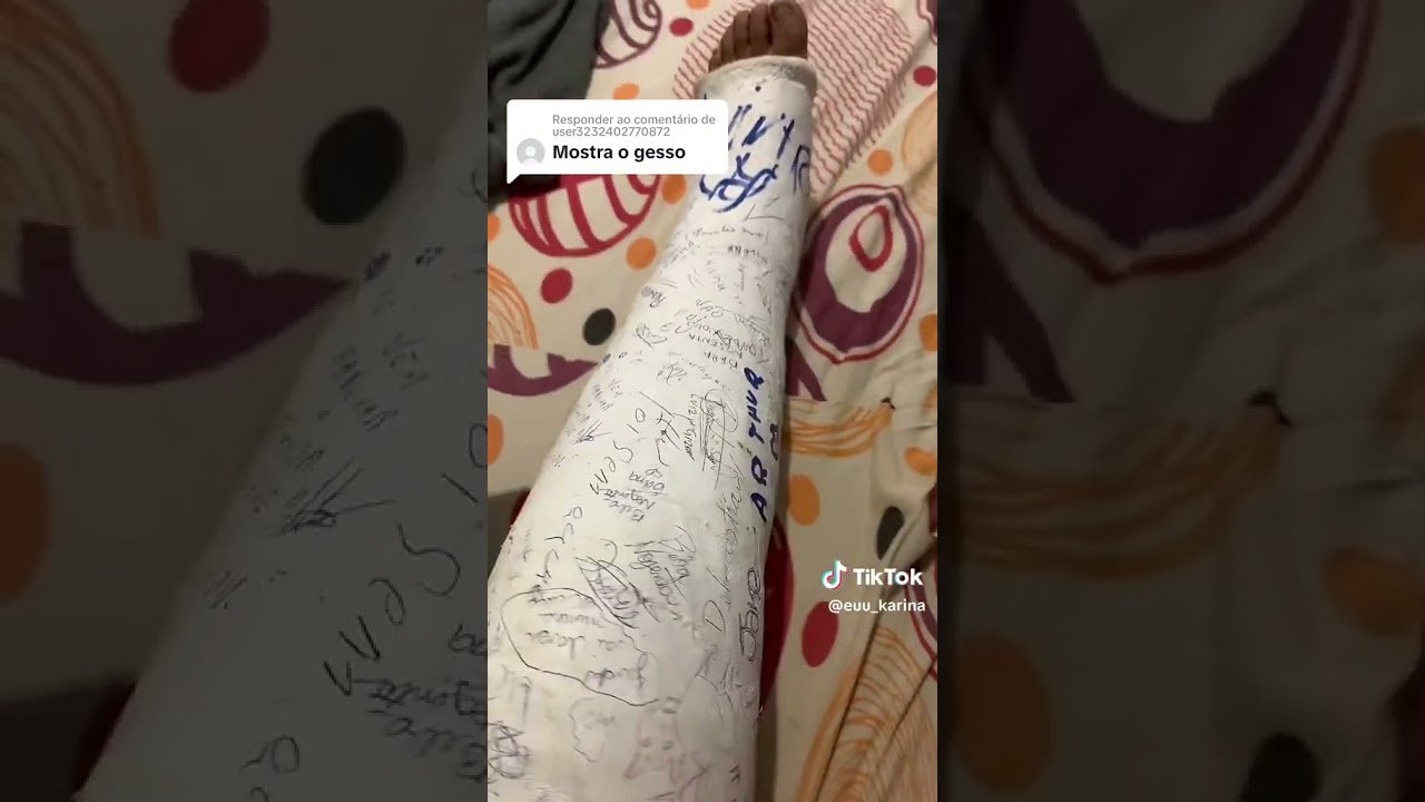Enyesada escayolada LONG LEG CAST #legcast