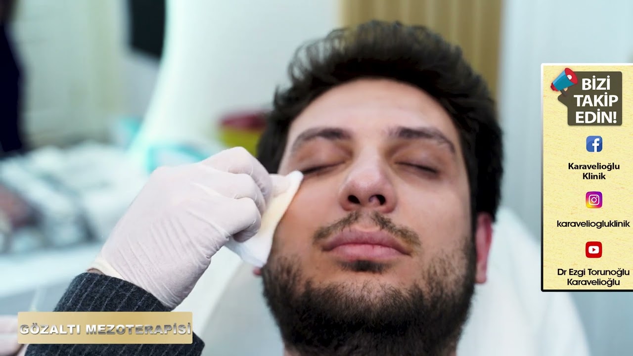 Gözaltı Mezoterapisi | Dr. Ulaş Karavelioğlu