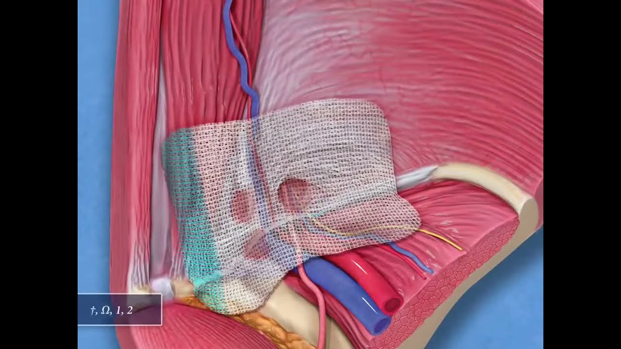 Анатомические сетки LPG ProGrip Laparoscopic Self Fixating Mesh