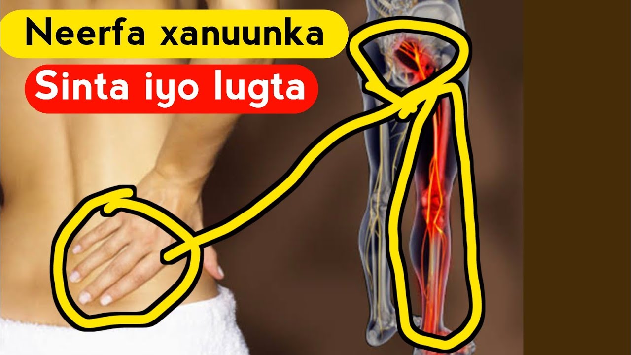 Xanuunka Neerfaha  dhabarka qeeybta Hoose ( sinta ) ilaa lugta Sida loo Daaweeyo with Dr Timajilac ✅