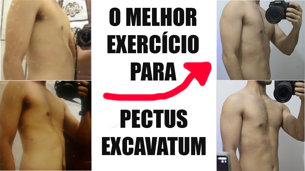 O melhor exercício para Pectus Excavatum