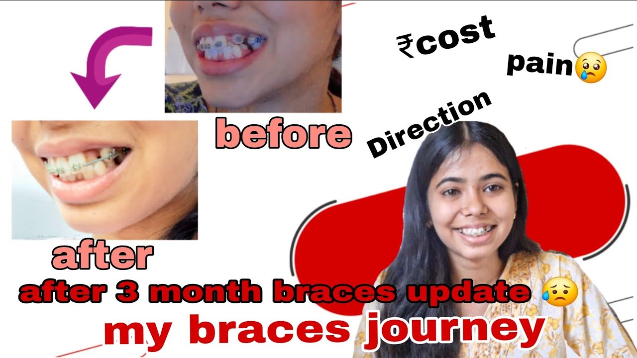 Meri Braces Journey 😨😭 before and after || 3 month braces full experience & transformation story 