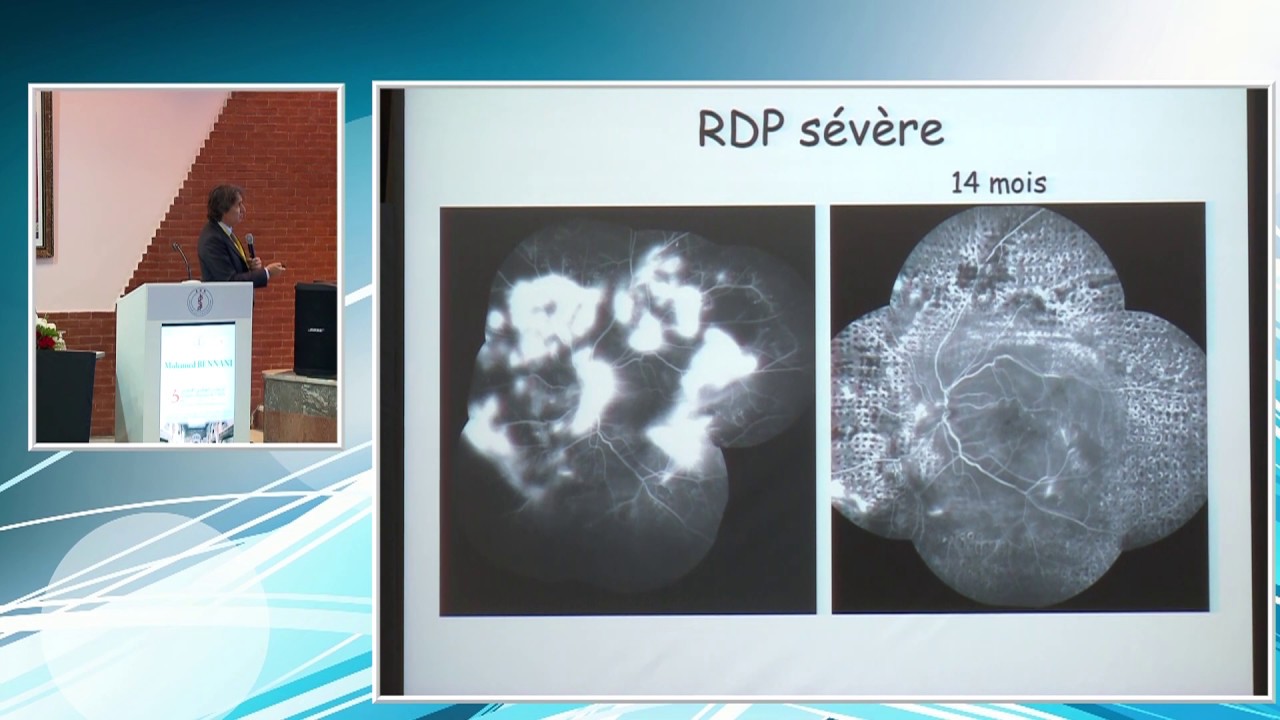 ADN 2018 - Rétinopathie diabétique - Dr. Mohamed BENNANI (Casablanca)