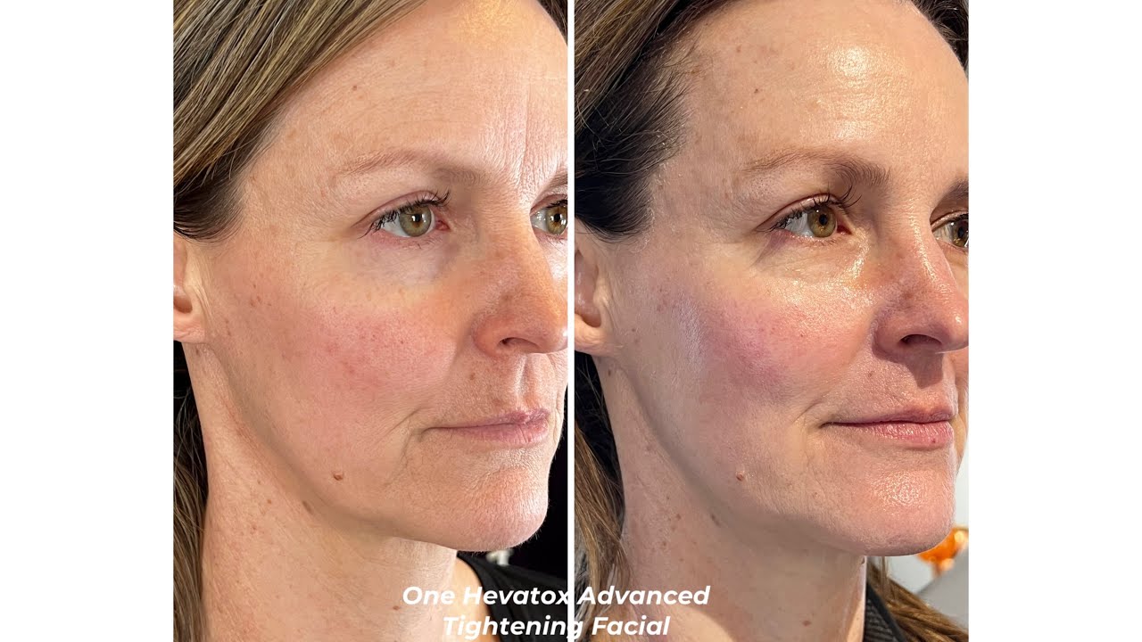 Skin Tightening Facial (with Topical Neurotoxin- Alt to injectable Botox)