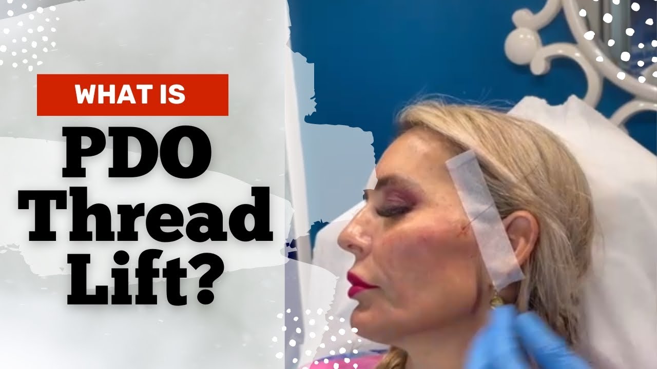 What is PDO thread lift? Best PDO Thread Lift In West Palm Beach Gardens | Beverly Hills Med Spa