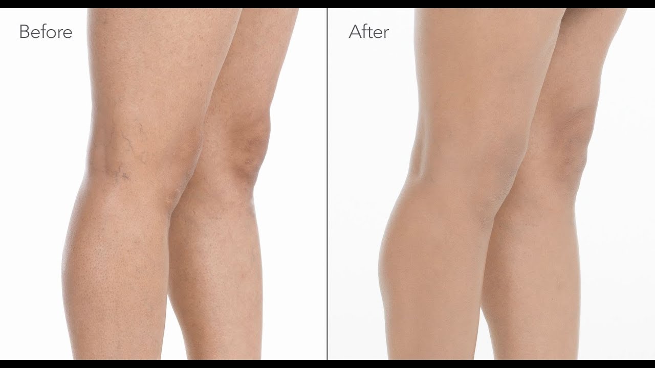 How to Cover Spider Veins on Legs with Makeup | jane iredale