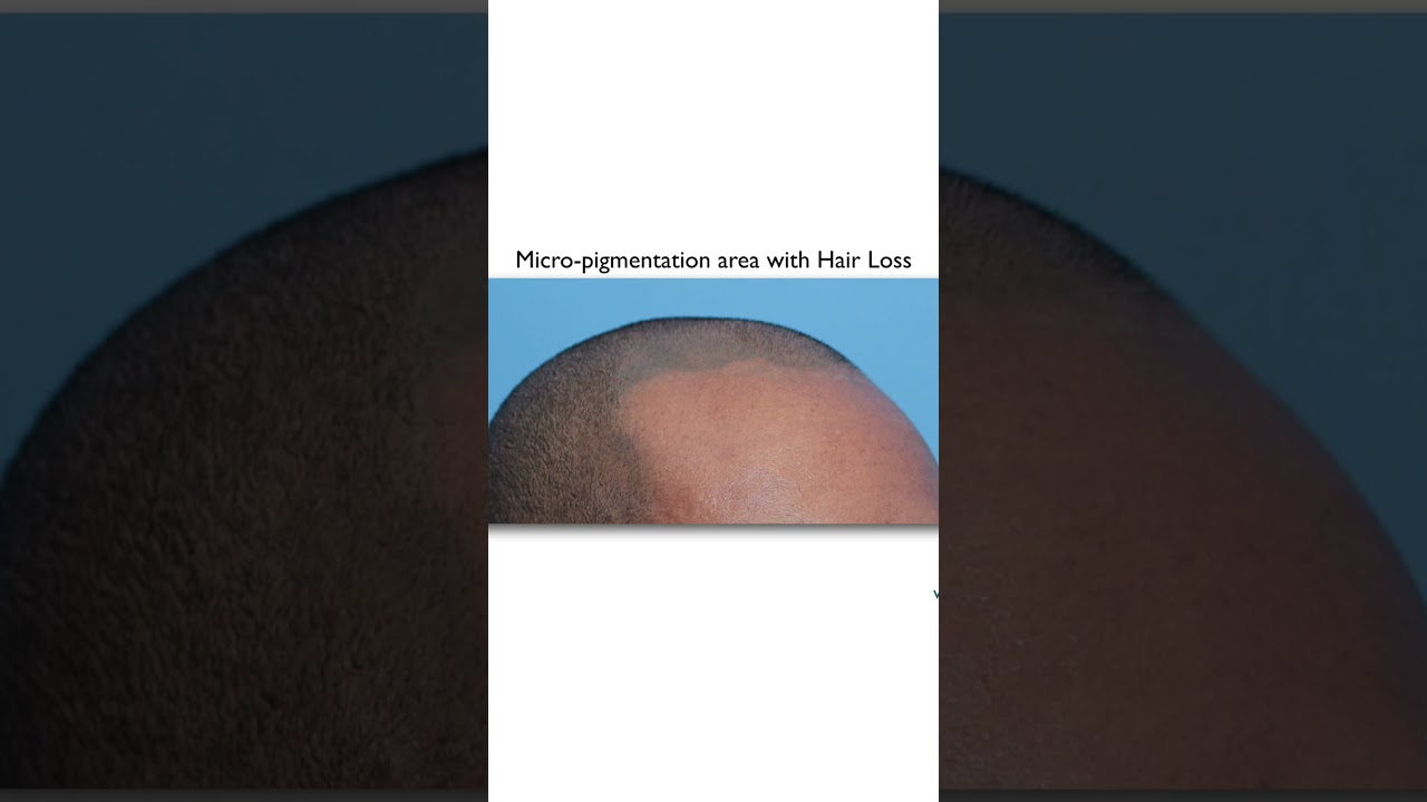 Scalp Micropigmentation Long-Term Results #scalpmicropigmentation