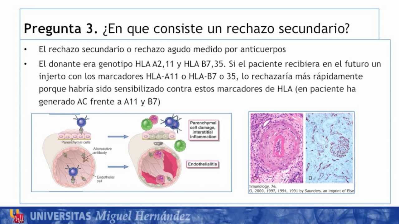 umh1947 2012-13 Caso006 Enfermedades de Base Inmune Diabetico 34 a&ntilde;os con Transplante Renal