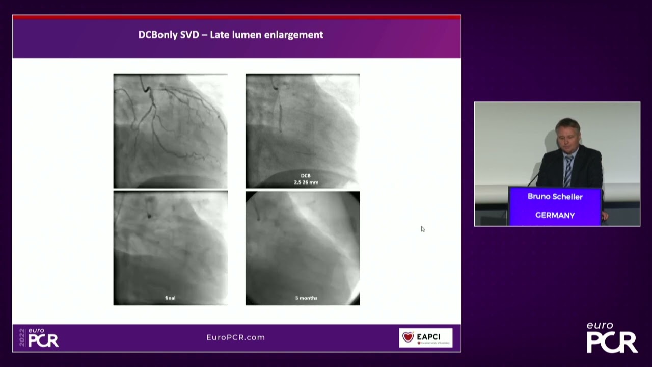 DCB and the possibility of a clean vessel - EuroPCR 2022