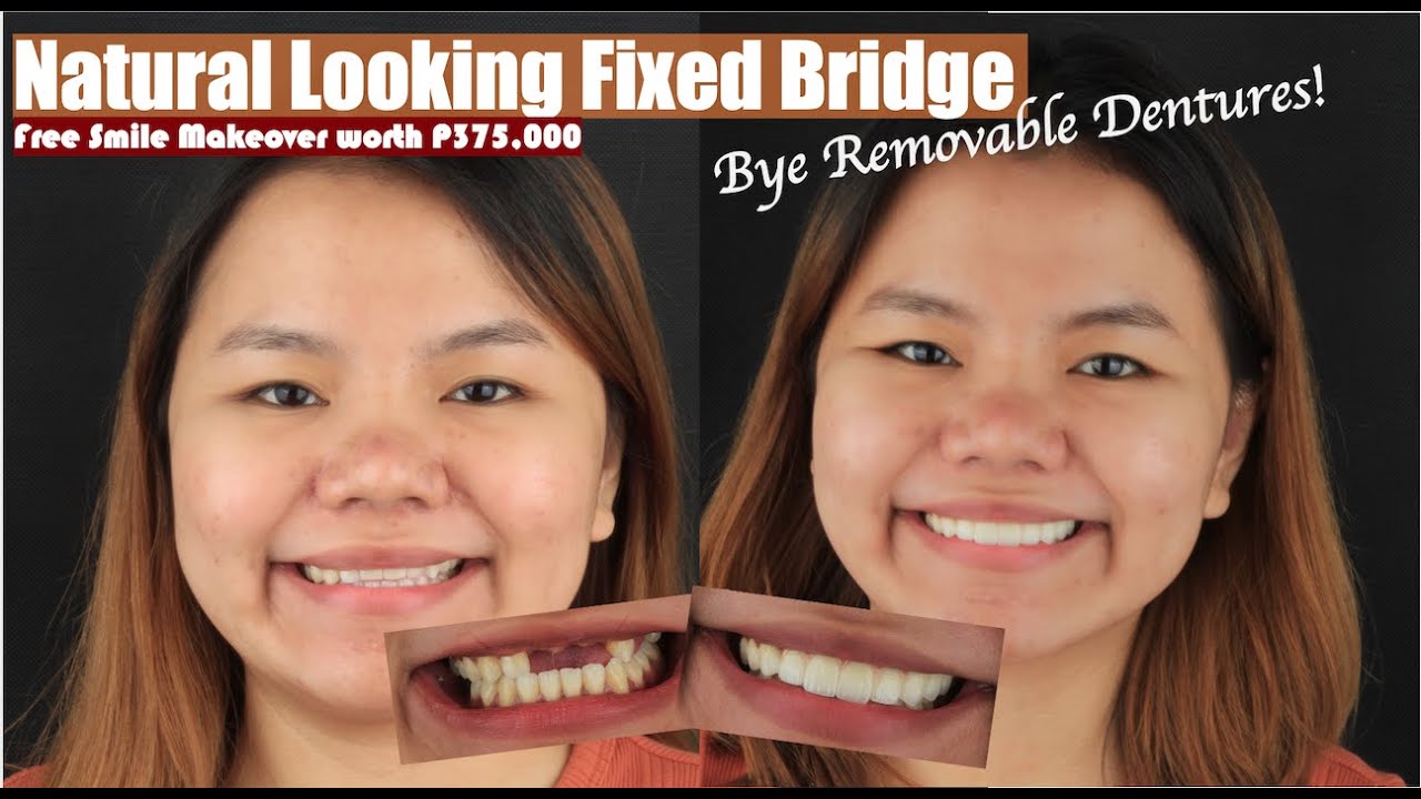 Fixed Dental Bridge to replace Removable Dentures | Apostol Dental Philippines