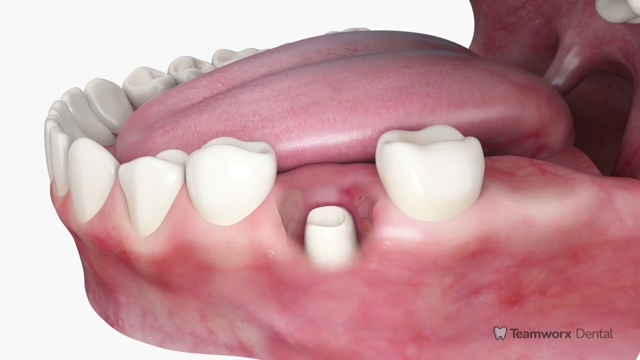 Immediate Implant (Back Tooth)