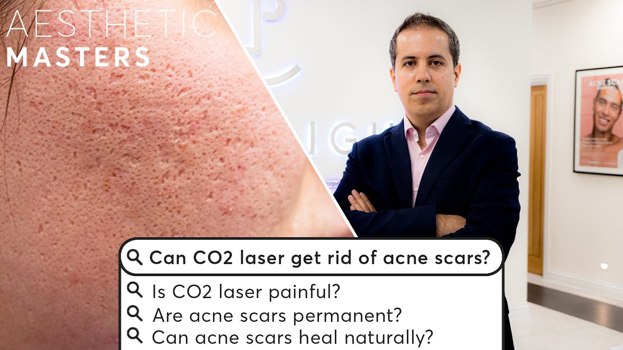 Can CO2 Fractional Laser Treat Acne Scars? Most Googled Questions
