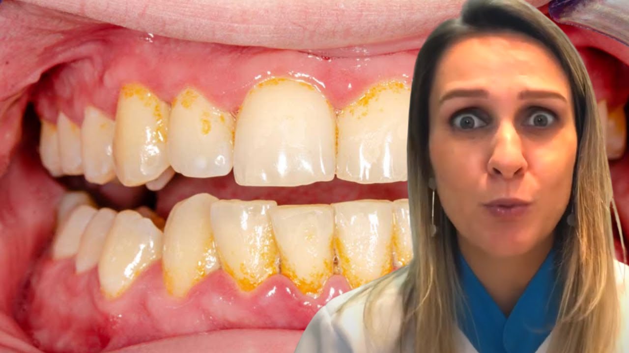 Tártaro no Dentes l Você Precisa fazer uma Limpeza Agora!