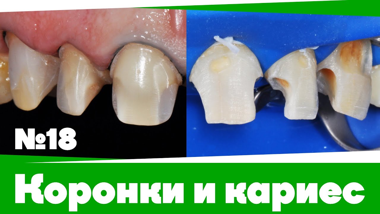 #Коронки и кариес | Дентал Кейсы от BG #18