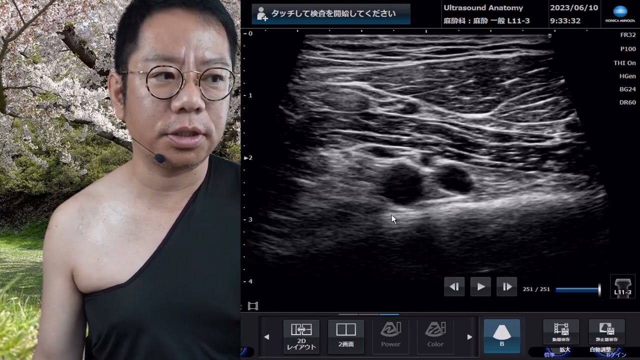 【妄想系！】鎖骨下静脈のエコー解剖