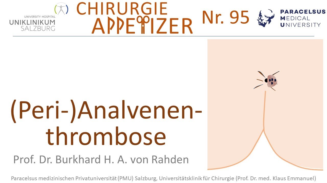 Analvenenthrombose Perianalvenenthrombose CHIRURGIE APPetizer Nr. 95