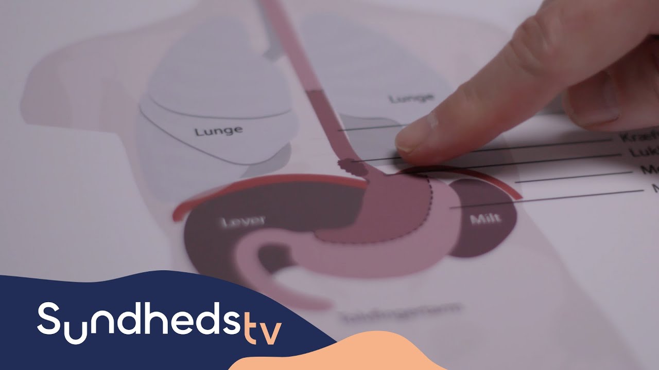 Spiserørskræft | Eksperten forklarer