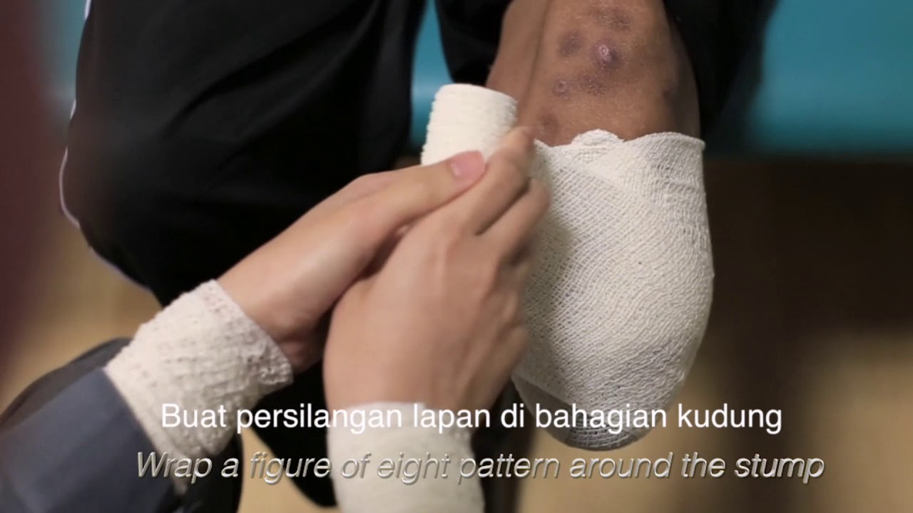 Stump bandaging techniques