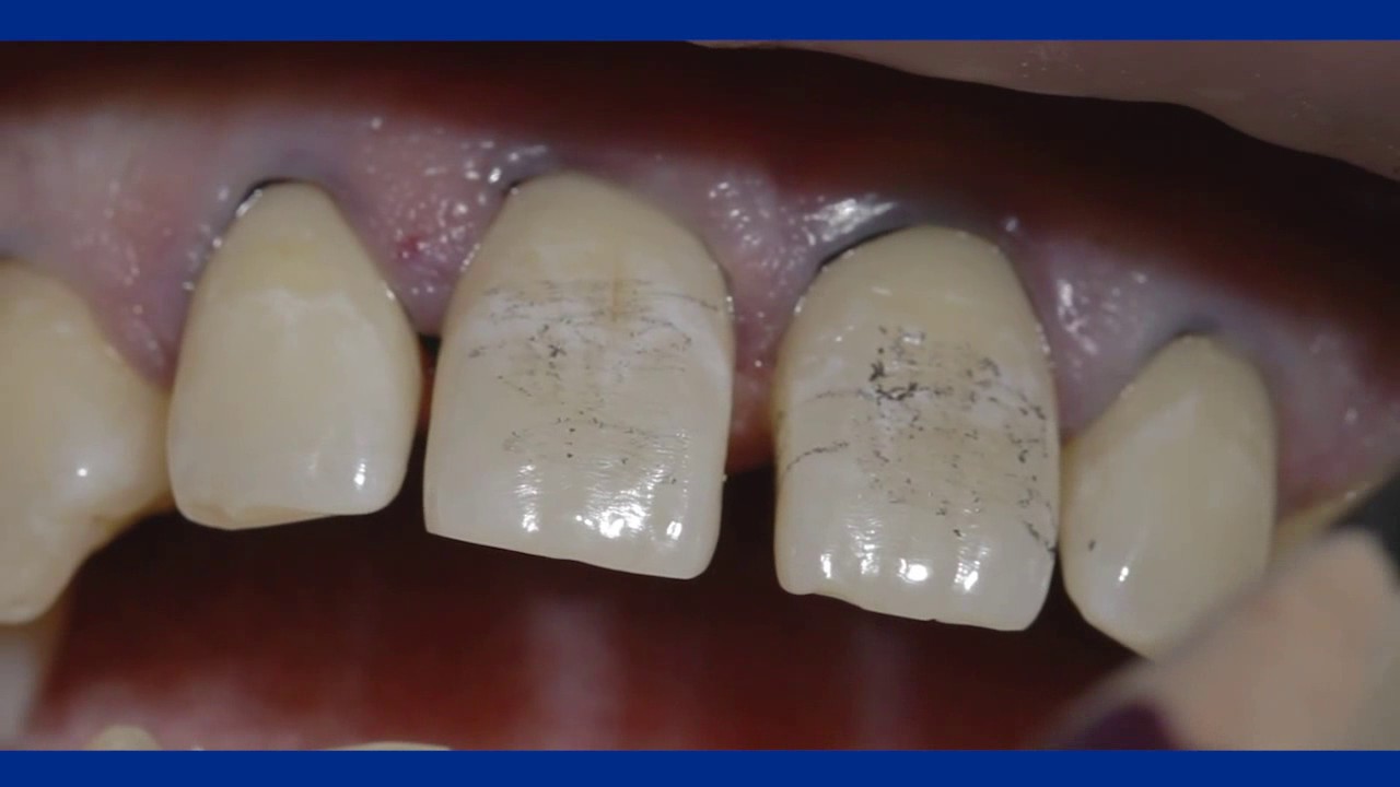 Fermeture de diastèmes au composite Dr David HACMOUN