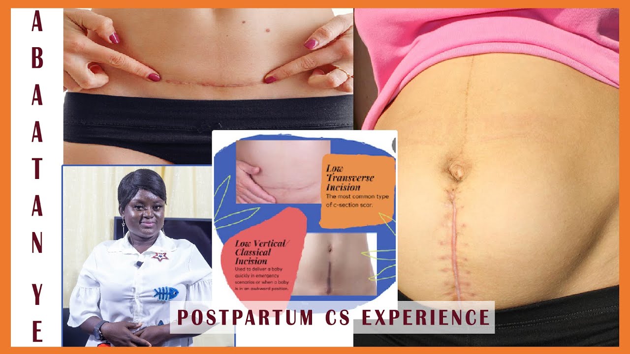 Postpartum CS Experience, planned C-section experience, how do I know my C-section is healing,