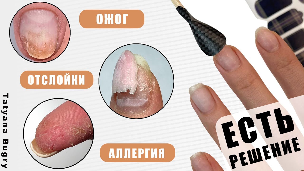 Отслойки ? Аллергия ? Ожог⚠️СТОП⚠️Есть РЕШЕНИЕ/ #ТатьянаБугрий