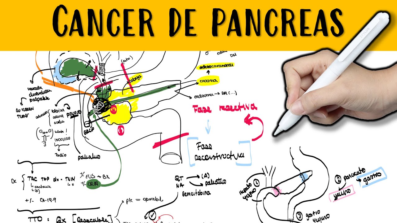 CANCER DE PANCREAS #cancer #pancreas #oncologia #ictericia #tumor #cirugia #digestivo